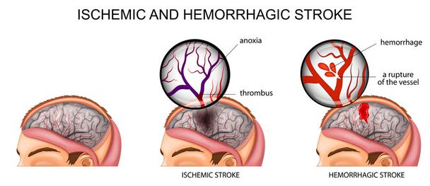 ischemic and hemorrhagic stroke - Vector, Image
