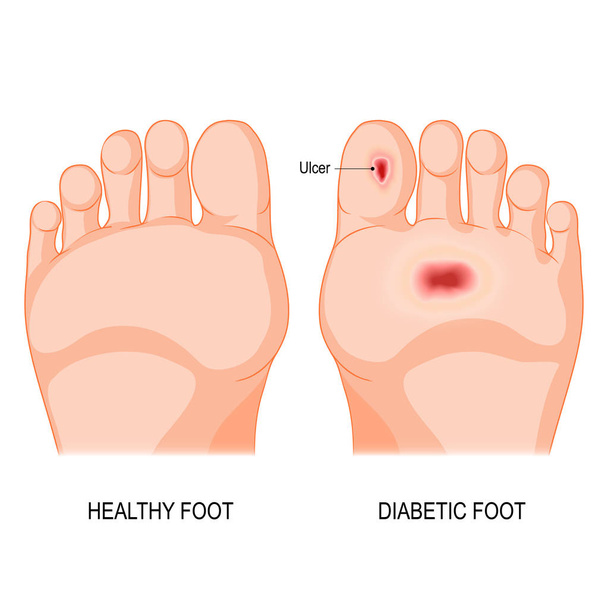diabetic foot. vector illustration - Vector, Image