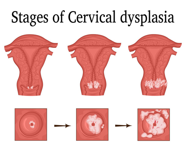 Illusztráció: cervicalis dysplasia - Vektor, kép