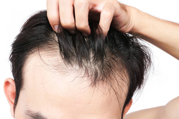 Young man serious hair loss problem for health care shampoo and  - Photo, Image