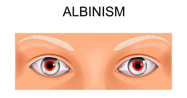τα μάτια κάποιου που πάσχουν από albinism - Διάνυσμα, εικόνα