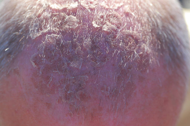 ustioni solari sulla testa maschile
 - Foto, immagini