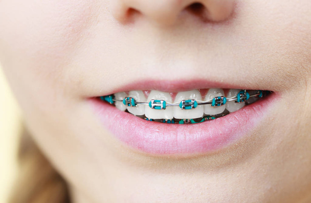 Closeup of woman teeth with braces - Foto, immagini