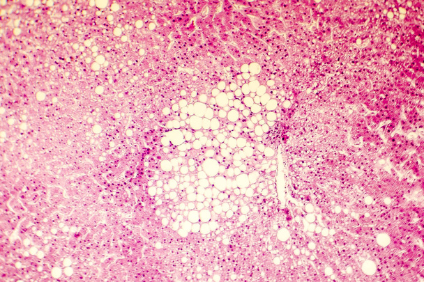 Micrografia leve de um fígado gorduroso
 - Foto, Imagem