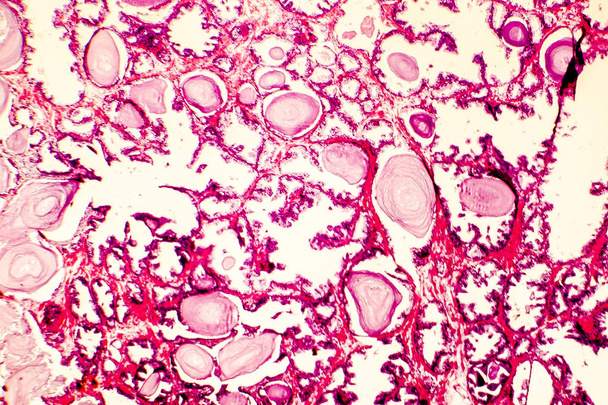 前立腺肥大症の顕微鏡写真 - 写真・画像