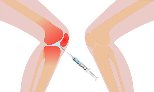 Knie Injektion Entzündung Rötung Vektor Illustration - Vektor, Bild