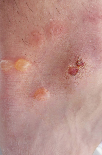 Close-up van Kaukasische man huid met blaren - Foto, afbeelding