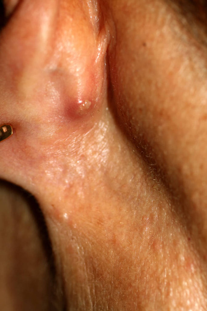 Un absceso detrás de la oreja. Espinilla roja inflamada
 - Foto, imagen