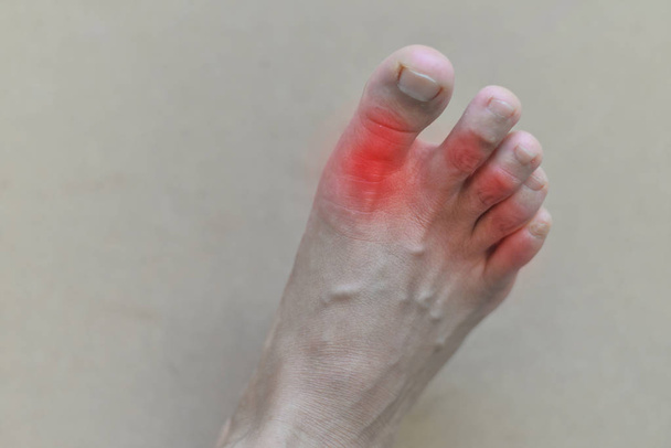 Painful and inflamed gout - Photo, Image