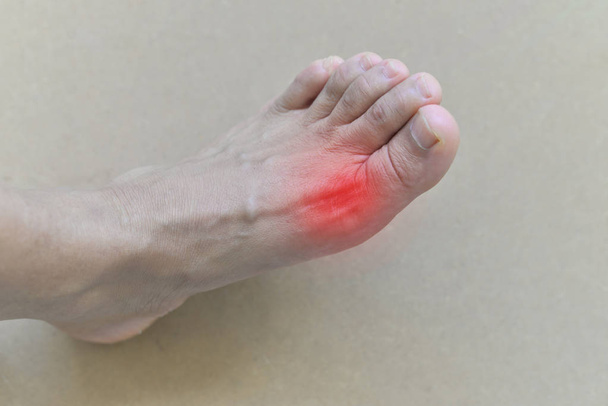 Painful and inflamed gout - Photo, Image