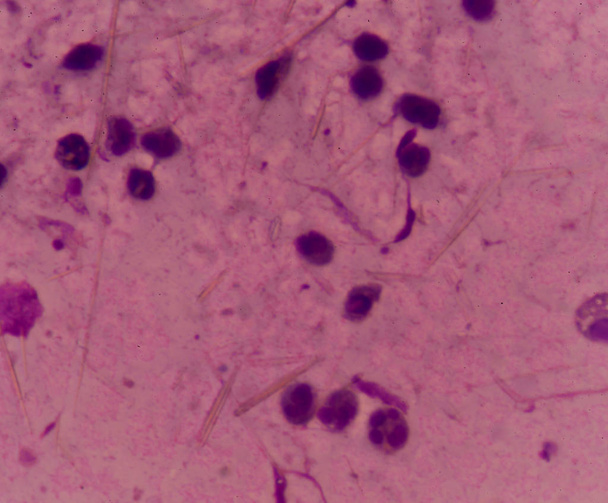 white blood cells with Uric acid crystal needle shape - Photo, Image