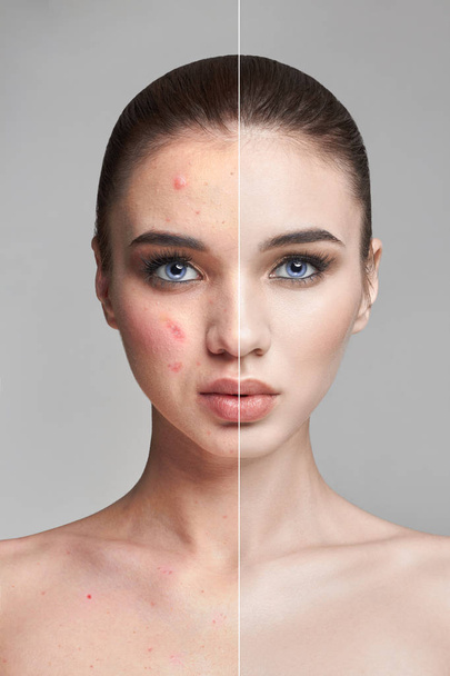 Pimples and acne on the woman's face before and after. Cosmetics to remove pimples and blackheads. Natural natural skin skin. Beautiful woman face closeup, dermatology. - Foto, Bild