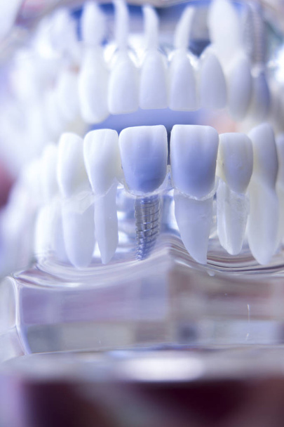 Οδοντιατρική Dentsts δοντιών εμφυτεύματος - Φωτογραφία, εικόνα