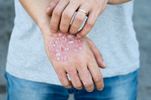 Man scratch oneself, dry flaky skin on hand with psoriasis vulgaris, eczema and other skin conditions like fungus, plaque, rash and patches. Autoimmune genetic disease. - Photo, Image