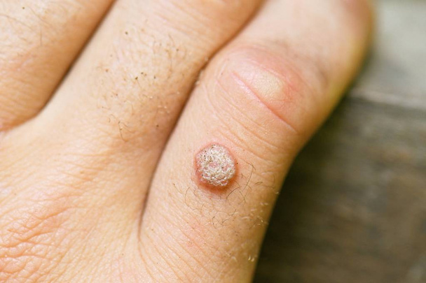 Wart no dedo da mão, close-up - Foto, Imagem