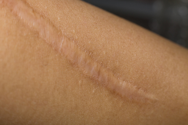 A Keloid on skin Body closeup image - Photo, Image