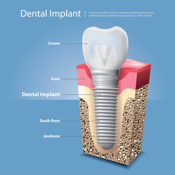Emberi fogak és fogimplantátum vektor illusztráció - Vektor, kép