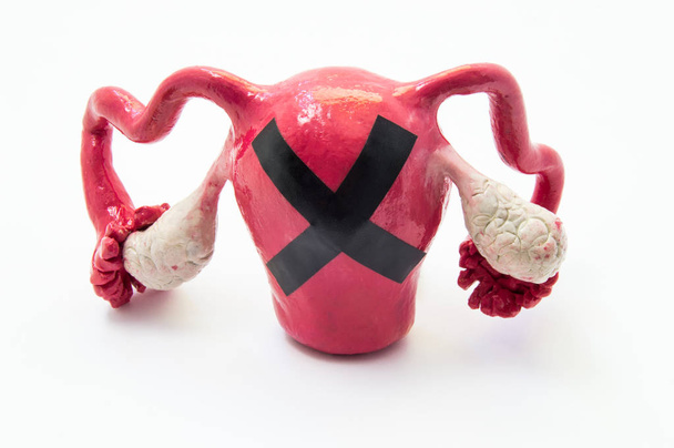 Female infertility concept. Model of female uterus with ovaries with black prohibiting cross on it. Photo symbolizing female infertility with cause of pathology of genital organs such as endometriosis - Photo, Image