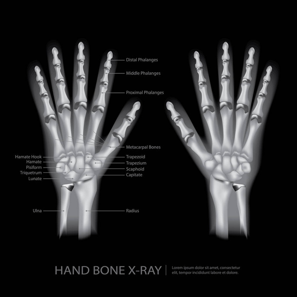 Εικονογράφηση φορέα ακτινογραφία των οστών χέρι - Διάνυσμα, εικόνα