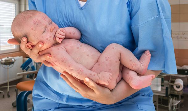 Bebé recién nacido con varicela, sarampión o rubéola
 - Foto, Imagen