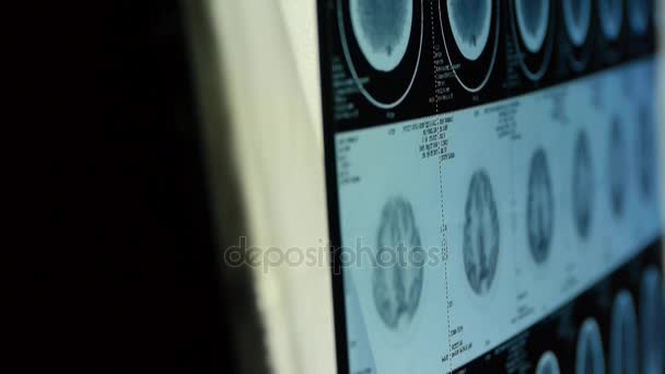 Doktor studie hlavy pet/ct scan pro analýzu choroby mozku lebku X-ray. - Záběry, video