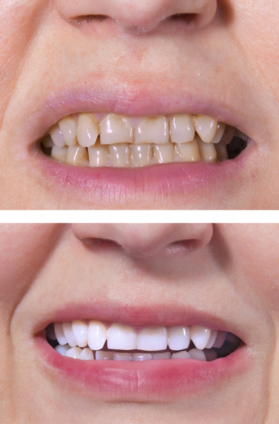 Fogak fogfehérítés - előtt és után - Fotó, kép