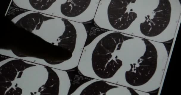 4k Doctors study head pet-ct skull brain scan X-ray film for analysis disease. - Footage, Video