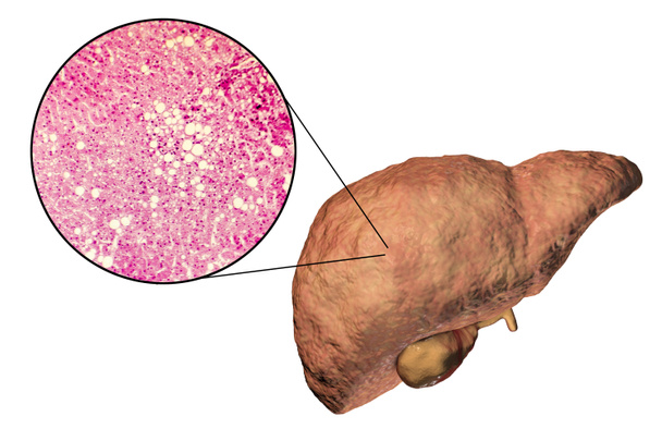 Fígado gordo, esteatose hepática
 - Foto, Imagem