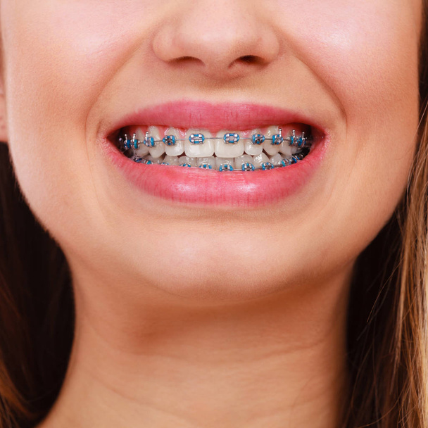 Woman showing her teeth with braces - Zdjęcie, obraz