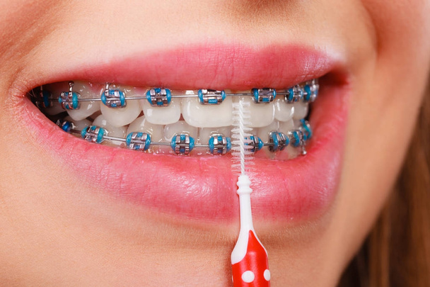 Woman smiling cleaning teeth with braces - 写真・画像