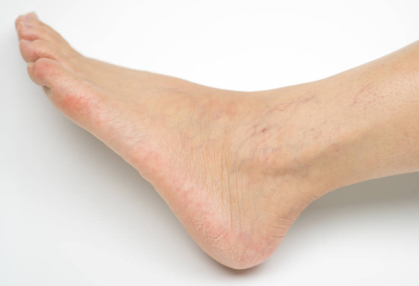 クローズ アップのひびの入ったかかととアジアの女性の足と足首のコピー スペースと白い背景で隔離の静脈瘤。ハイヒールを身に着けているから問題. - 写真・画像