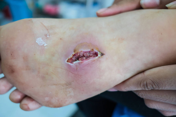 ferita da infezione da primo piano ai piedi dei pazienti
  - Foto, immagini