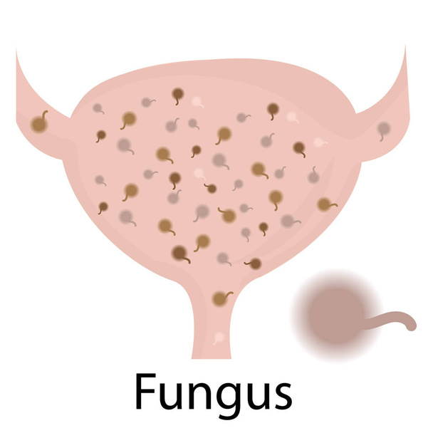 Infezione del tratto urinario. Fungo
 - Vettoriali, immagini