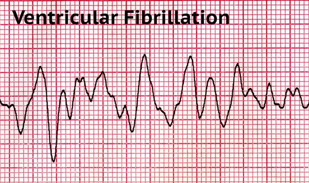 Ventricular Fibrillation - Deadly Heart Rhythm - Photo, Image