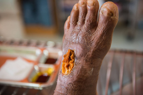 Nahaufnahme Infektionswunde im Fuß des Patienten . - Foto, Bild