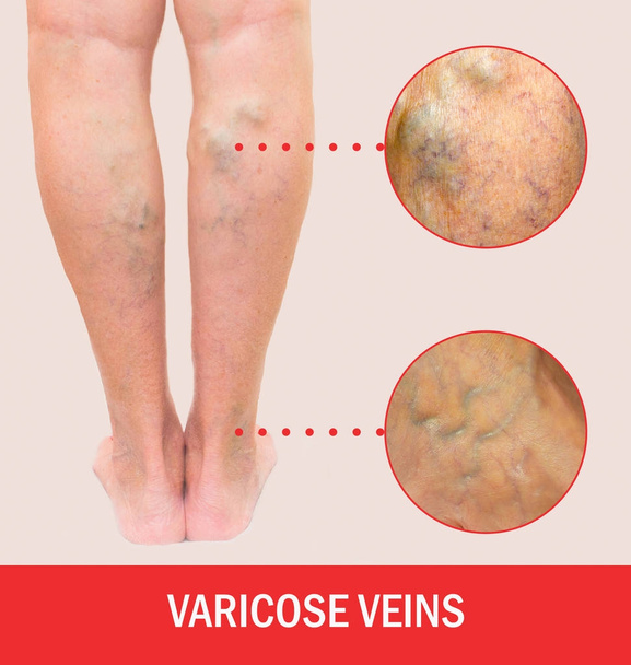 Painful varicose veins,,spider veins, varices on a severely affected leg. Ageing, old age disease, aesthetic problem concept. - Photo, Image