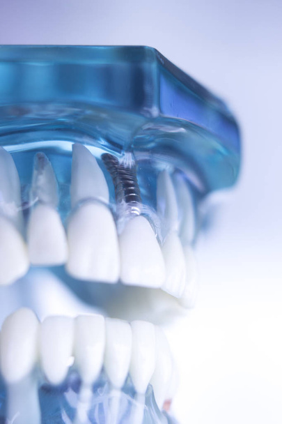 Зубной имплантат
 - Фото, изображение