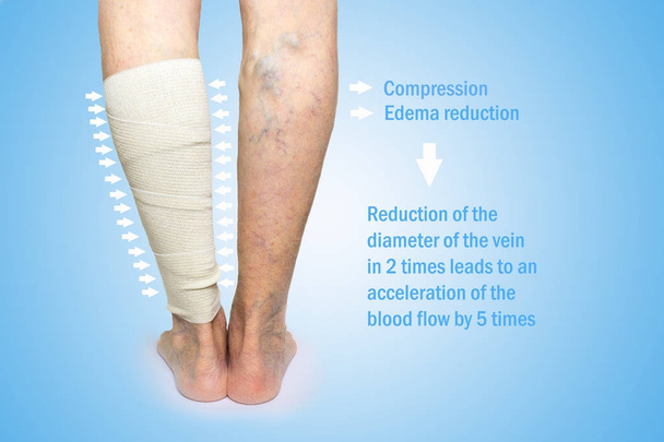 Legs. Varicose veins. Phlebeurysm. Thrombophlebitis. Elastic bandage - Photo, Image