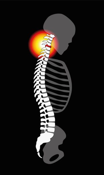 Spinal Disc wypadanie kręgów szyjnych ból szyi - Wektor, obraz
