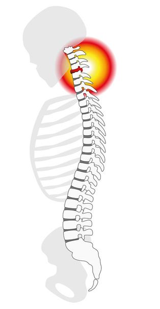 Dolor en el cuello Vértebras cervicales Prolapso del disco espinal
 - Vector, Imagen