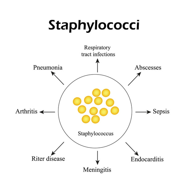 Estafilococos. Staphylococcus aureus causa enfermedades. Infografías. Ilustración vectorial
 - Vector, Imagen