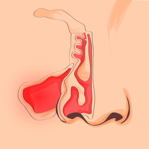 Ανατομία της μύτης και του λαιμού. Δομή των ανθρώπινων οργάνων. Εικονογράφηση από ιγμορίτιδα, rinitis, πόνος στη μύτη - Διάνυσμα, εικόνα