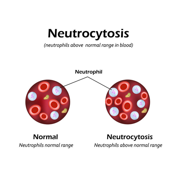 Los neutrófilos estaban por encima del rango normal en la sangre. Neutrocitosis. Ilustración vectorial
 - Vector, Imagen