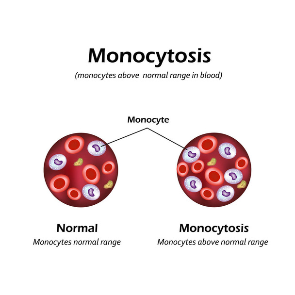 A monociták a vérben normál tartomány felett. Monocytosis. Vektoros illusztráció - Vektor, kép