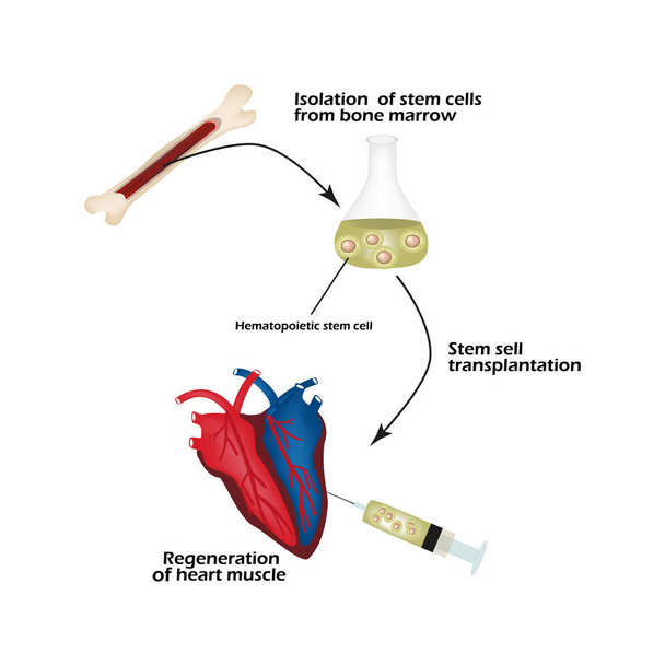 Células-tronco da medula óssea são usadas para regenerar o músculo cardíaco. Infográficos. Ilustração vetorial
 - Vetor, Imagem