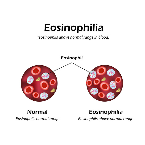 Eosinophiles au-dessus de la normale dans le sang. Éosinophilie. Infographie. Illustration vectorielle
 - Vecteur, image