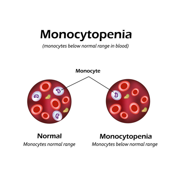 Monocytes below the normal range in the blood. Monocytopenia. Vector illustration - Vector, Image