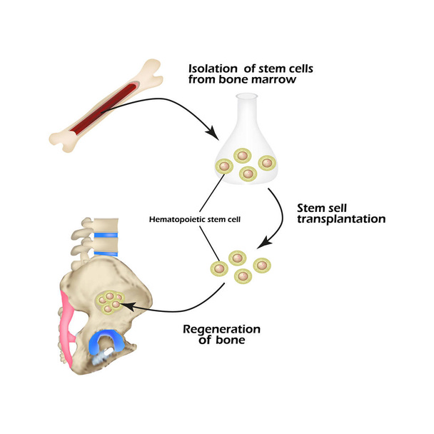 Las células madre de la médula ósea se utilizan para la regeneración ósea. Infografías. Ilustración vectorial
 - Vector, Imagen