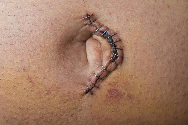 Chirurgie de réparation de hernie ombilicale
 - Photo, image