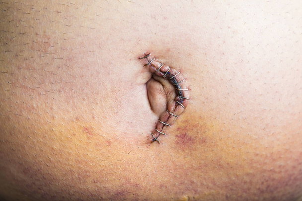Chirurgie de réparation de hernie ombilicale
 - Photo, image